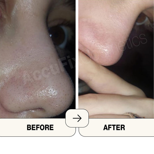 AccuFix - Salicylic Acid Cream