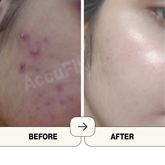 AccuFix - Salicylic Acid Cleanser