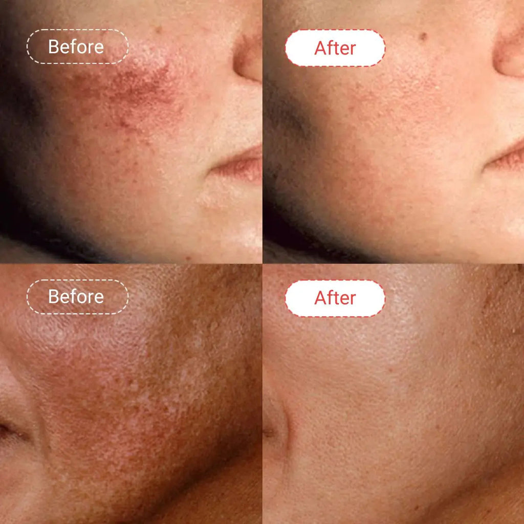 AccuFix - Azelaic Acid Serum