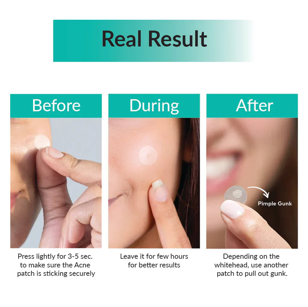 Some by Mi - 30 Days Miracle Clear Spot patch - 18 Patches