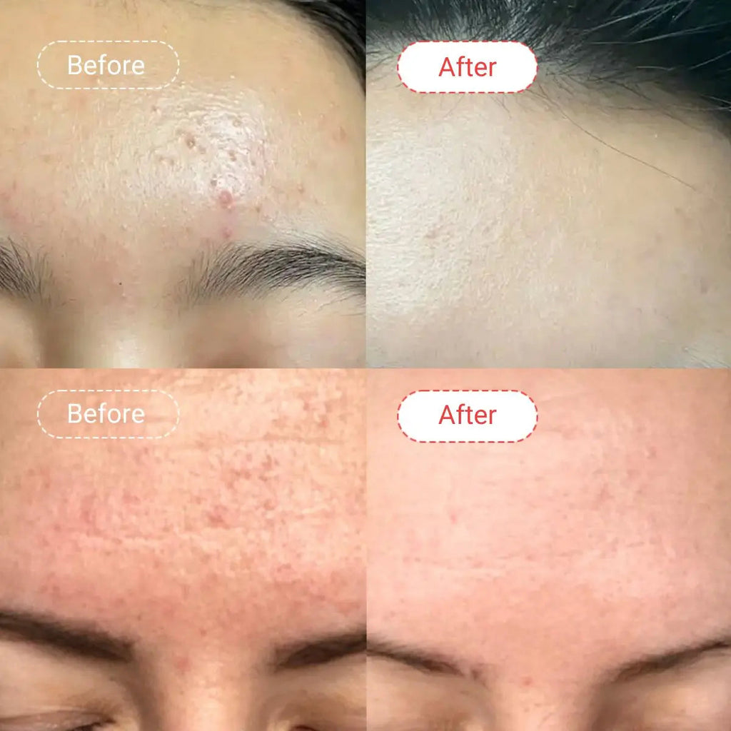 AccuFix - Salicylic Acid Serum | BHA Serum