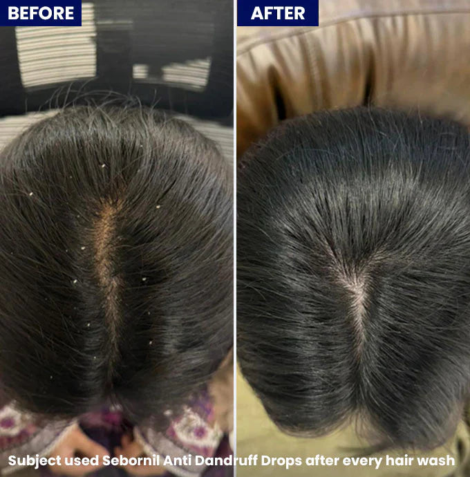 Jenpharm - Sebornil Anti-Dandruff Drops