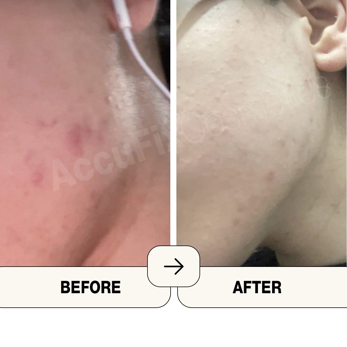 AccuFix - Salicylic Acid Face Wash Gel